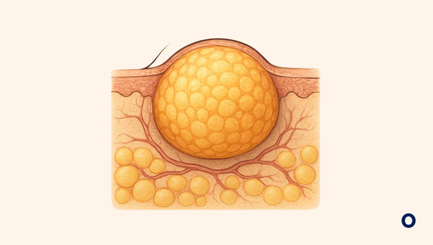 usuń tłuszczaka Kraków - Oslomed Kraków