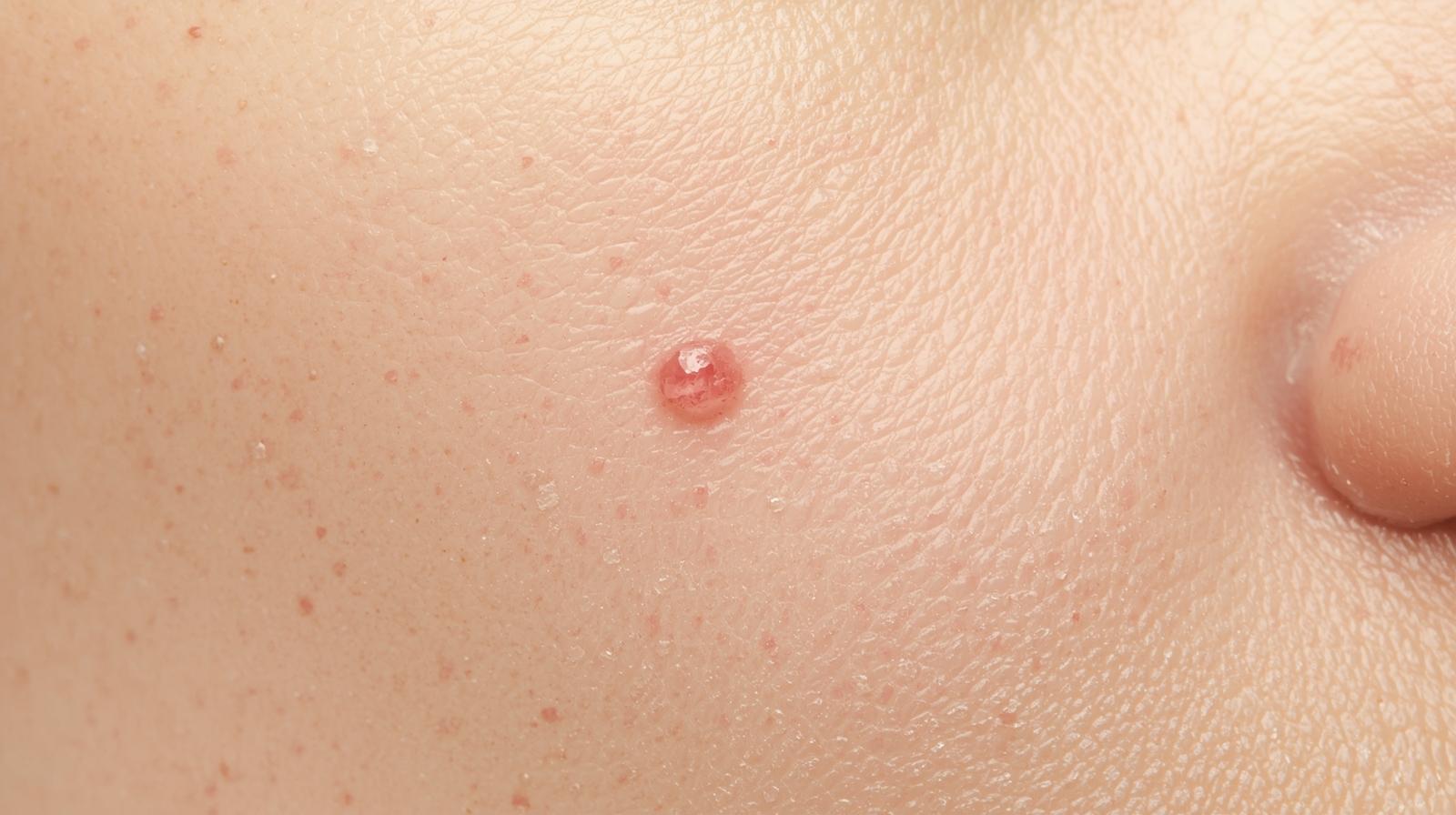 Usuwanie pieprzyka Kraków, usuń pieprzyka Kraków